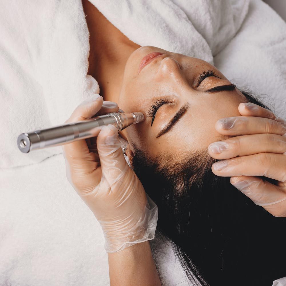 Microneedling by Birgit Holzmann